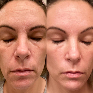 Before and after comparison image showing improved skin after LED light therapy